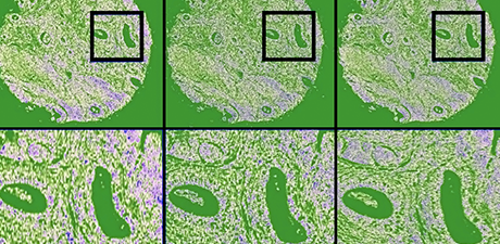 Rapid Hyperspectral Photothermal Mid-Infrared Spectroscopic Imaging from Sparse Data for Gynecologic Cancer Tissue Subtyping