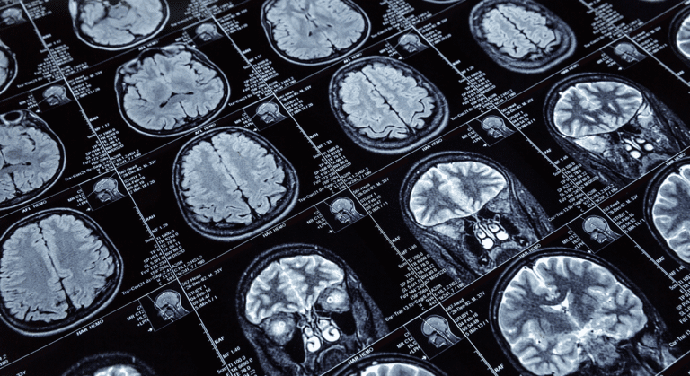 Lipid mediated formation of antiparallel aggregates in cerebral amyloid angiopathy