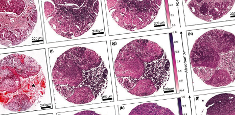investigation of lymph nodal metastases of oral squamous cell carcinoma
